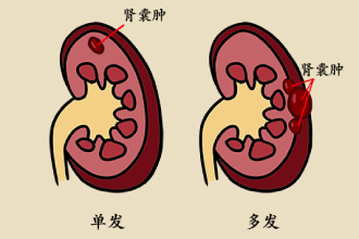 单纯性肾囊肿要不要切了