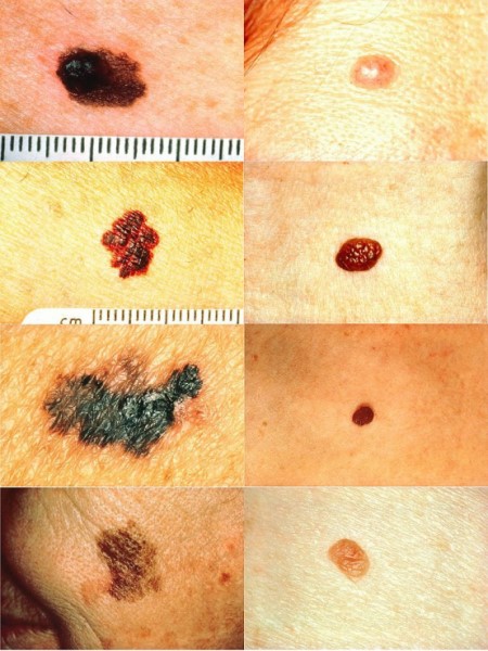 5个小贴士:通过观察痣判断皮肤癌