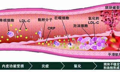 血管里脂质斑块形成过程